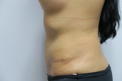 Abdominoplasty
