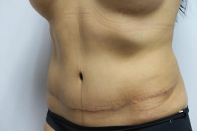 Abdominoplasty
