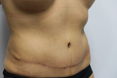 Abdominoplasty
