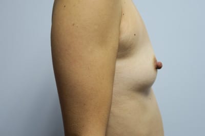 Breast Augmentation