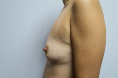Breast Augmentation