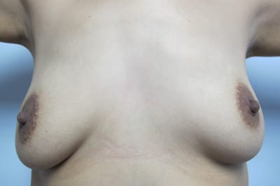 Breast Augmentation