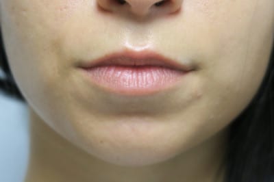 Lip Augmentation