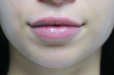 Lip Augmentation