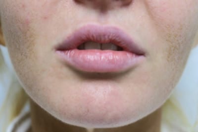 Lip Augmentation