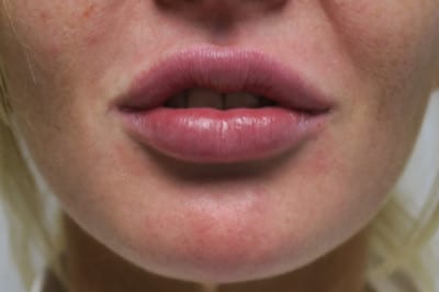 Lip Augmentation