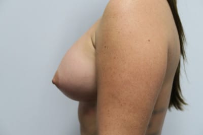 Breast Augmentation