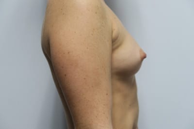 Breast Augmentation