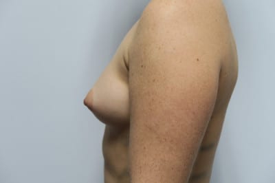 Breast Augmentation