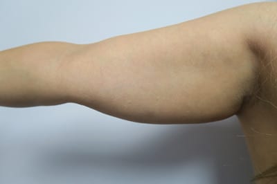 Brachioplasty