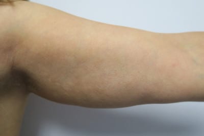 Brachioplasty