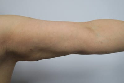 Brachioplasty