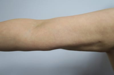 Brachioplasty