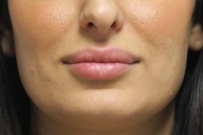 Lip Augmentation