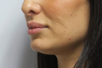 Lip Augmentation