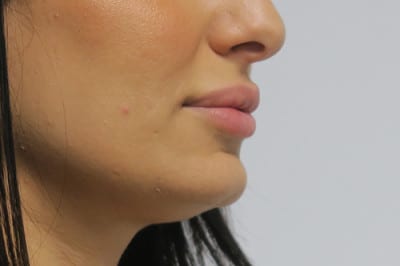 Lip Augmentation