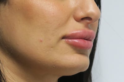 Lip Augmentation