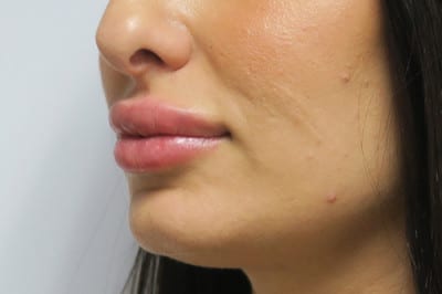 Lip Augmentation