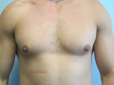 Gynecomastia