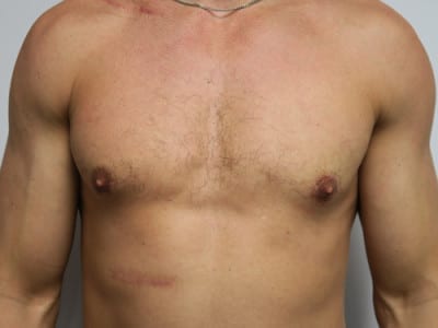 Gynecomastia