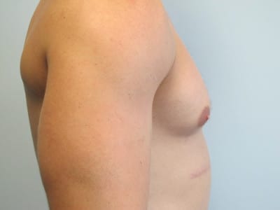Gynecomastia