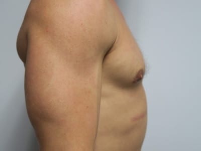 Gynecomastia