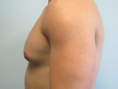Gynecomastia