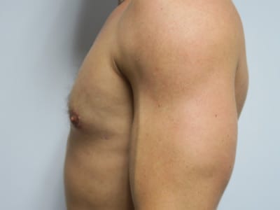 Gynecomastia