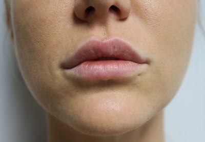 Lip Augmentation