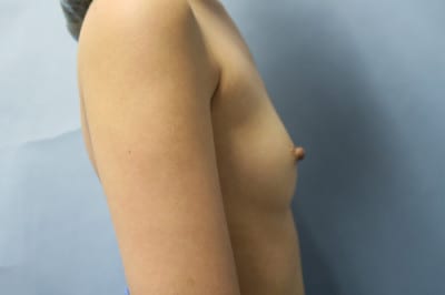 Breast Augmentation