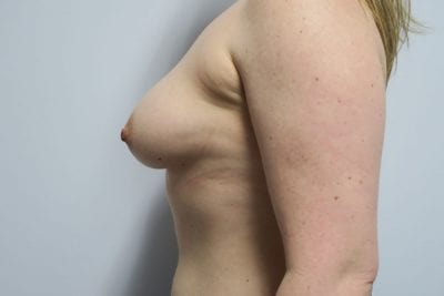 Breast Augmentation