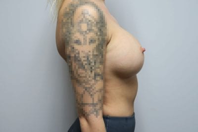 Breast Implant Exchange