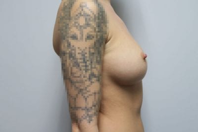 Breast Implant Exchange