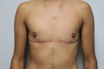 Top Surgery FTM