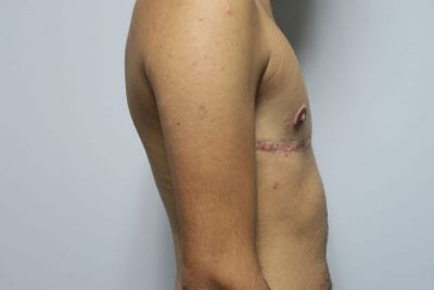 Top Surgery FTM