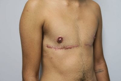 Top Surgery FTM