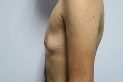 Top Surgery FTM