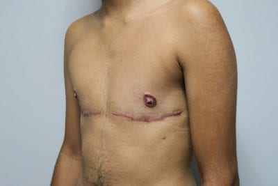 Top Surgery FTM
