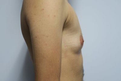 Top Surgery FTM