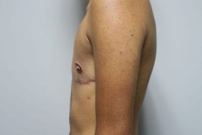 Top Surgery FTM