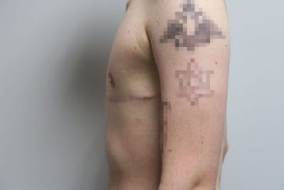 Top Surgery FTM
