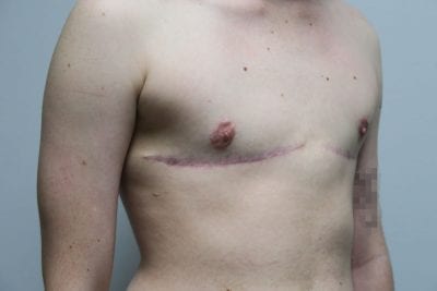 Top Surgery FTM