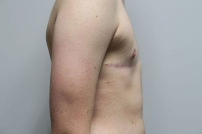 Top Surgery FTM