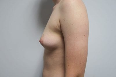 Top Surgery FTM