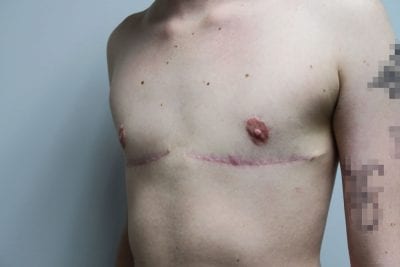 Top Surgery FTM