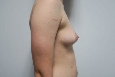 Top Surgery FTM