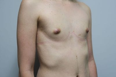 MTF Breast Augmentation