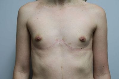 MTF Breast Augmentation