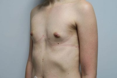 MTF Breast Augmentation