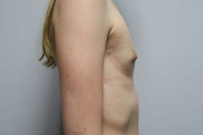 MTF Breast Augmentation
